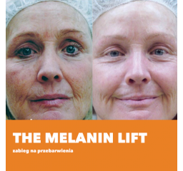 The Melanin Lift - zabieg na przebarwienia