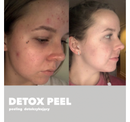 Detox Peel - peeling detoksykujący