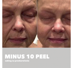 Minus 10 Peel - zabieg anti-age