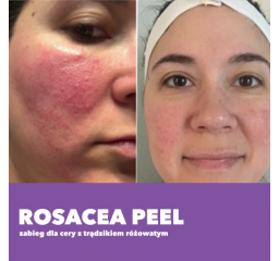 Rosacea Peel - Peeling do cery z trądzikiem różowatym