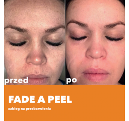 Fade A Peel - zabieg na przebarwienia.