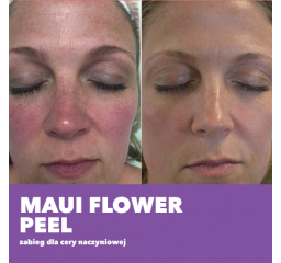 Maui Flower Peel - zabieg dla cery naczyniowej.