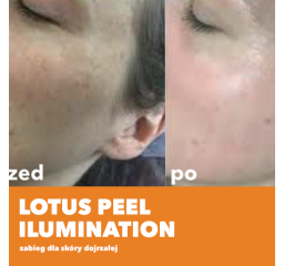 Lotus Peel Ilumination - zabieg dla skóry dojrzałej.